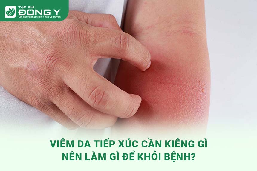 viem-da-tiep-xuc-can-kieng-gi
