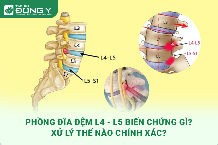 phong-dia-dem-l4-l5