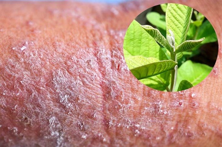 Tác dụng của lá ổi trong điều trị viêm da cơ địa