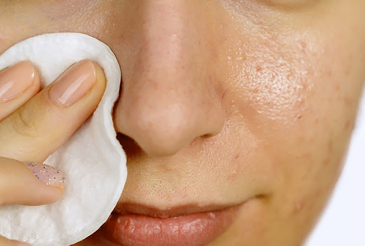 Nguyên tắc trị viêm da tiết bã hiệu quả