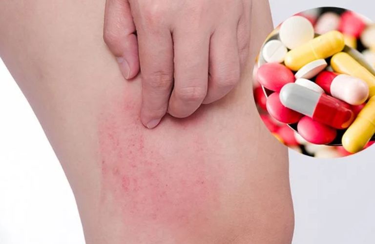 Thuốc kháng sinh làm thuyên giảm mẩn đỏ thông qua việc tác động vào căn nguyên