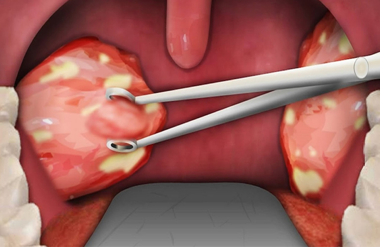 Cắt amidan là phương pháp điều trị có thể được chỉ định trong một số trường hợp