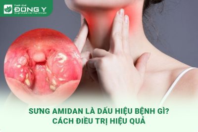sưng amidan