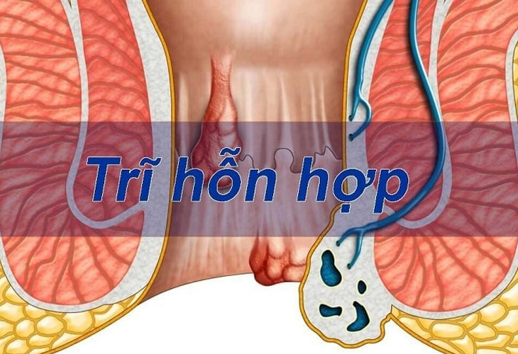 tri-hon-hop