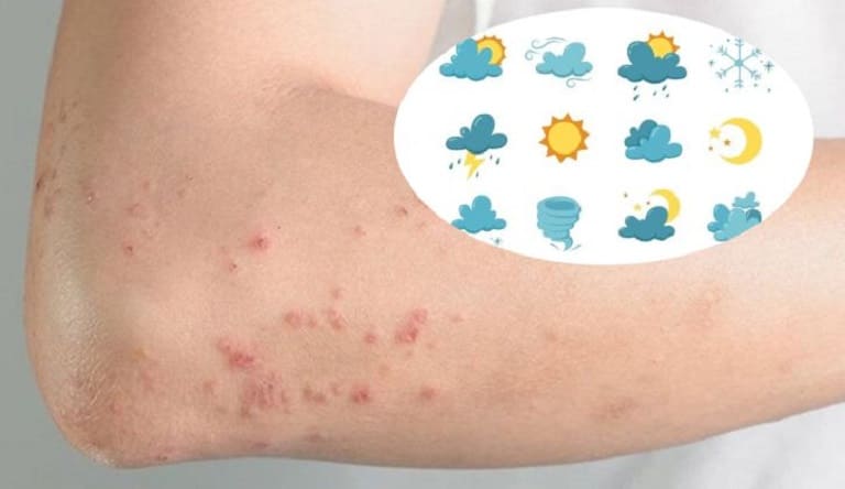 Dị ứng thời tiết dễ xuất hiện các mẩn đỏ gây ngứa ngáy, khó chịu