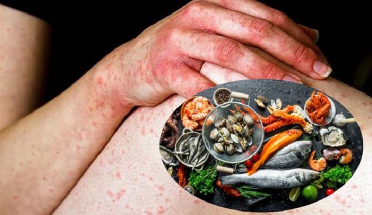 Dị ứng thức ăn có thể khiến mẩn đỏ bùng phát