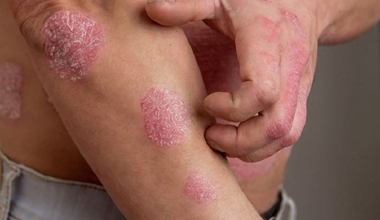 Các chứng bệnh da liễu như mề đay, chàm, ghẻ lở, hắc lào, … đều có một điểm chung là gây mẩn đỏ