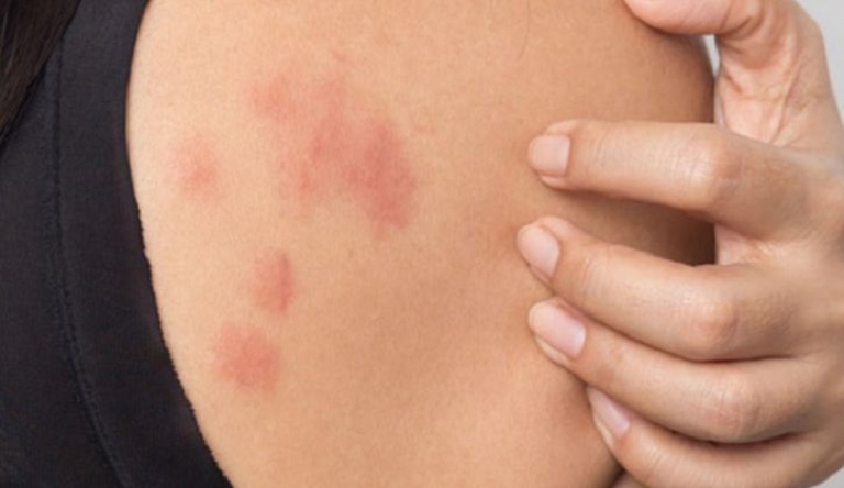 Nổi mẩn đỏ là một thuật ngữ chung chỉ tình trạng da bị mẩn đỏ