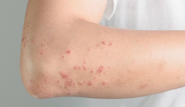 Xuất hiện nốt mẩn đỏ trên bất kỳ vị trí nào trên cơ thể 