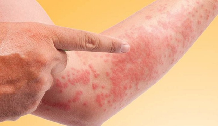 Dị ứng là nguyên nhân hàng đầu dẫn đến nổi mẩn đỏ 