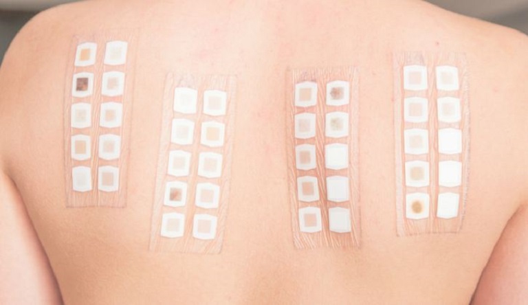 Xét nghiệm da là một phương pháp xét nghiệm không xâm lấn