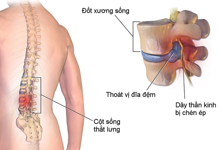 thoat-vi-dia-dem