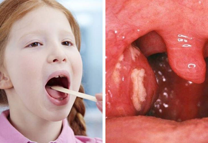 Trẻ viêm amidan với trường hợp nặng cần sử dụng thuốc điều trị