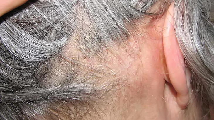 Nếu không điều trị kịp thời thì bệnh gây ra các biến chứng gây hại cho cơ thể