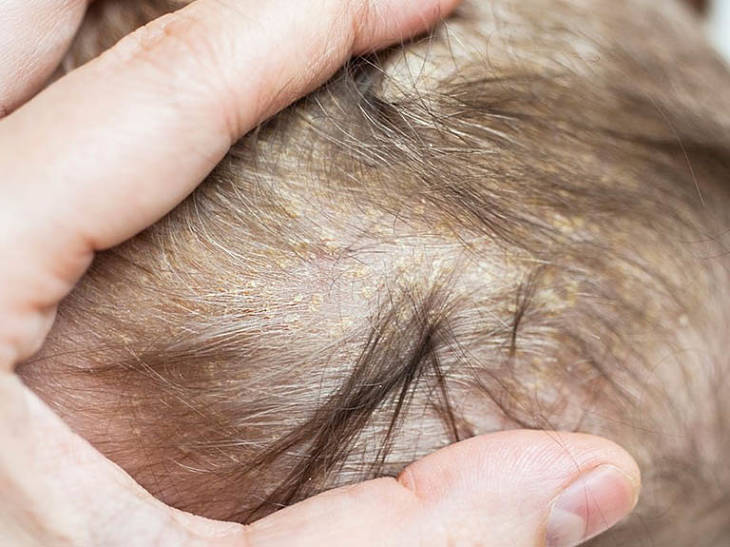 Viêm da tiết bã ở trẻ sơ sinh khiến trẻ cảm thấy khó chịu, ngứa ngáy