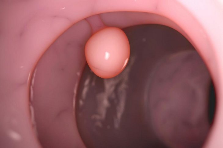Cắt polyp hay không còn phụ thuộc vào nhiều yếu tố