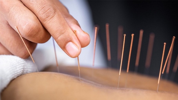 Cách trị vảy nến da đầu bằng châm cứu