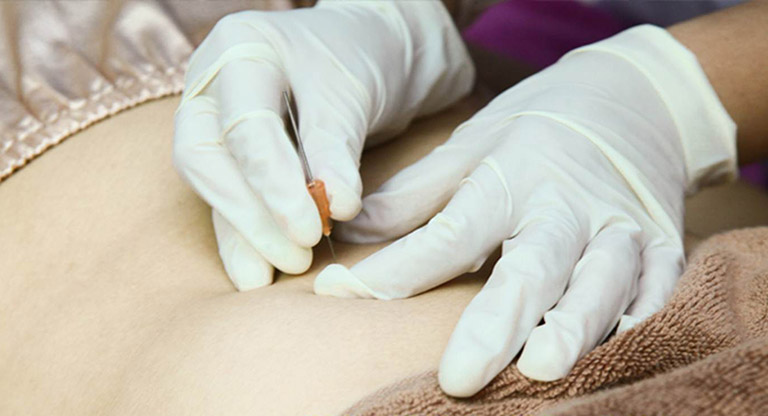 Cấy chỉ chữa đau vai gáy