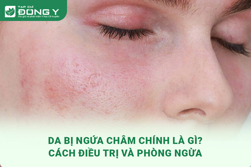 da-bi-ngua-cham-chich