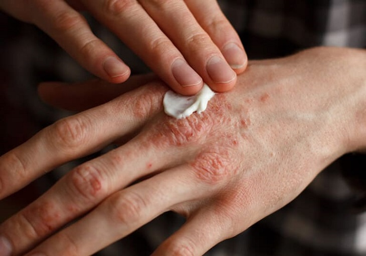 Một số tác dụng phụ có thể xảy ra nếu người bệnh không chăm sóc da đúng cách