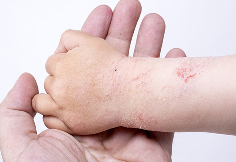 Trẻ nhỏ là đối tượng dễ bị á sừng