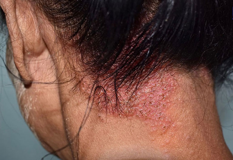Á sừng da đầu là bệnh thường gặp và đang có xu hướng gia tăng