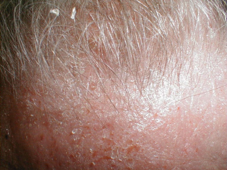Á sừng da đầu