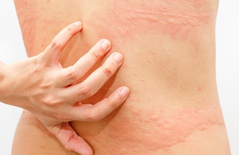 Xác định yếu tố gây dị ứng giúp bạn dễ dàng điều trị bệnh