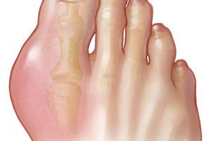 hinh-anh-gout-1