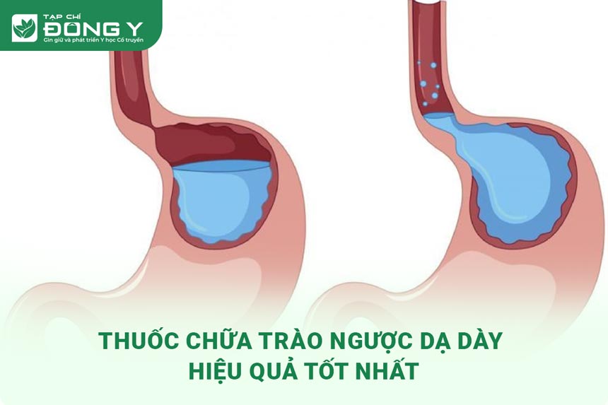hinh-anh-thuoc-chua-trao-nguoc-da-day-1
