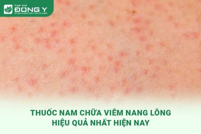 thuoc-nam-chua-viem-nang-long
