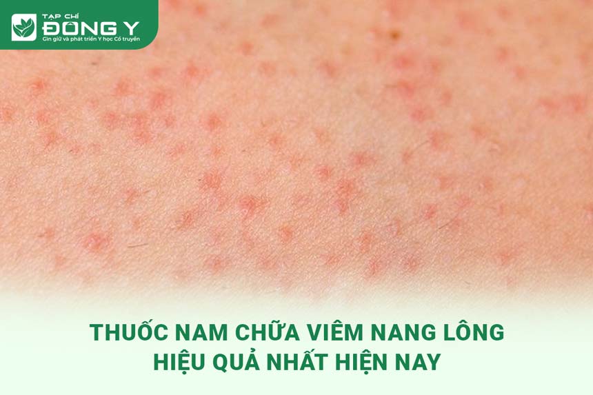 thuoc-nam-chua-viem-nang-long