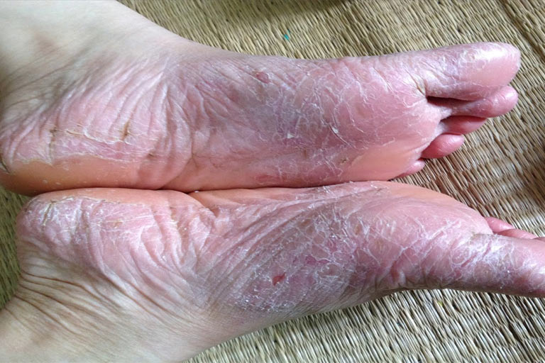 Tổ đỉa là bệnh lý da liễu mãn tính