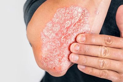 Vảy nến gây ra bởi sự tăng sinh quá mức của tế bào da