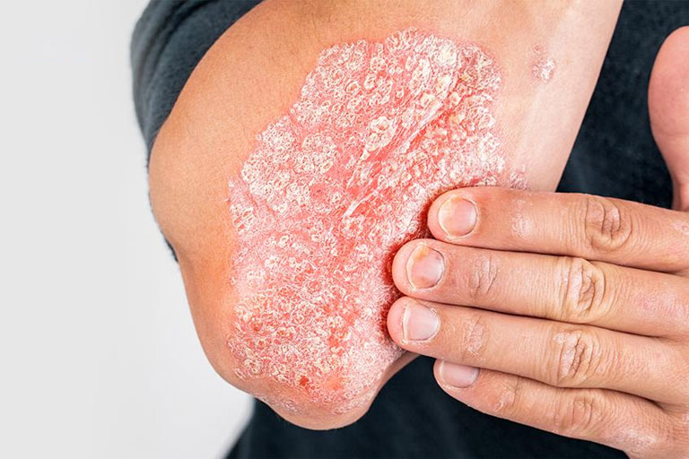 Vảy nến gây ra bởi sự tăng sinh quá mức của tế bào da