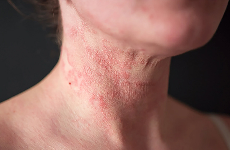 Vảy nến ở cổ là bệnh lý mãn tính và dai dẳng