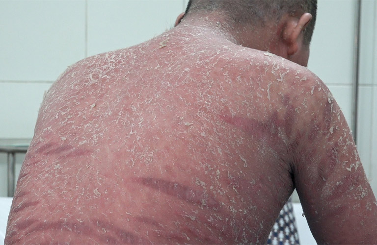 Vảy nến toàn thân là bệnh lý mãn tính nguy hiểm