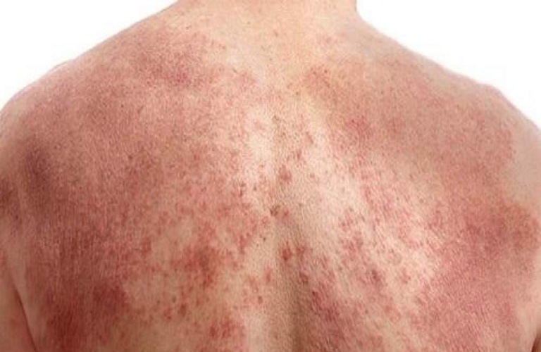 Viêm da cơ địa là bệnh mãn tính, gây ngứa rát, hình thành mảng viêm da đỏ, rỉ dịch