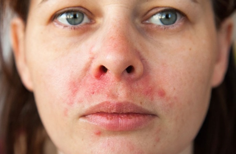 Viêm da cơ địa quanh miệng hay còn gọi là viêm da tiếp xúc corticosteroid