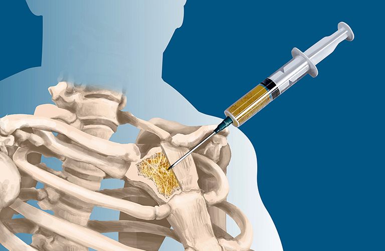 Xét nghiệm sinh thiết để chẩn đoán bệnh