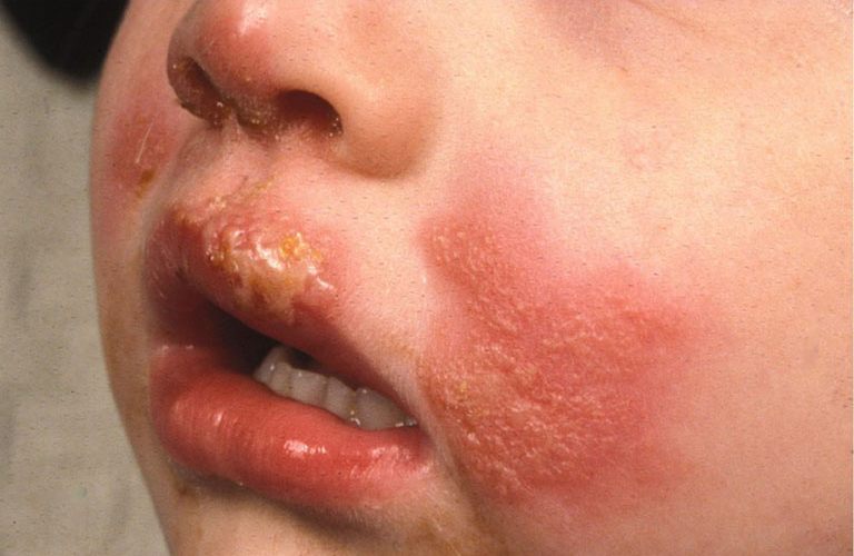 Trẻ sơ sinh là đối tượng dễ mắc bệnh