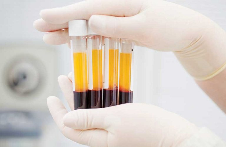 Người bệnh kháng trị với steroid có thể được chỉ định thay huyết tương trị bệnh