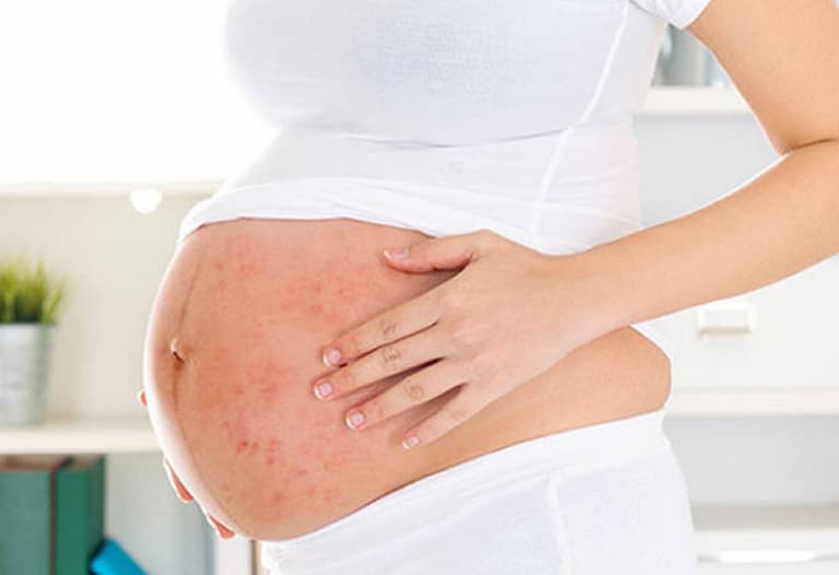 Á sừng khi mang thai trở thành bệnh phổ biển với nhiều mẹ bầu hiện nay 