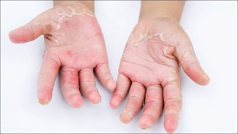 Bàn tay nứt nẻ, tróc vảy của phụ nữ bị á sừng khi mang thai 