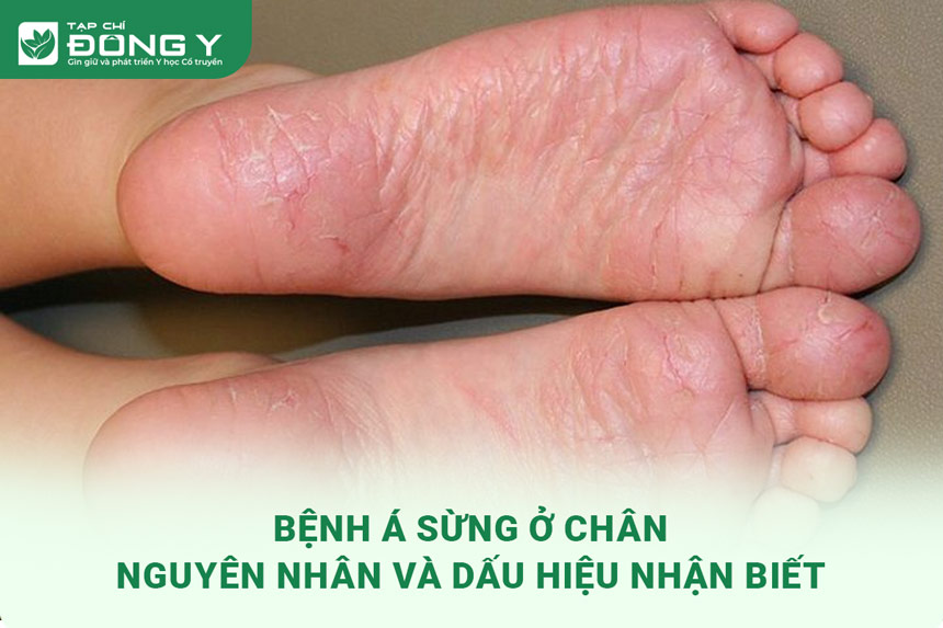 benh-a-sung-o-chan