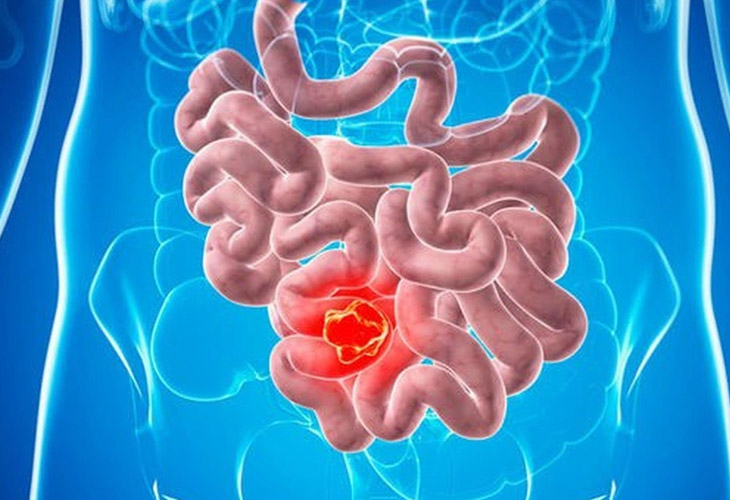 benh crohn