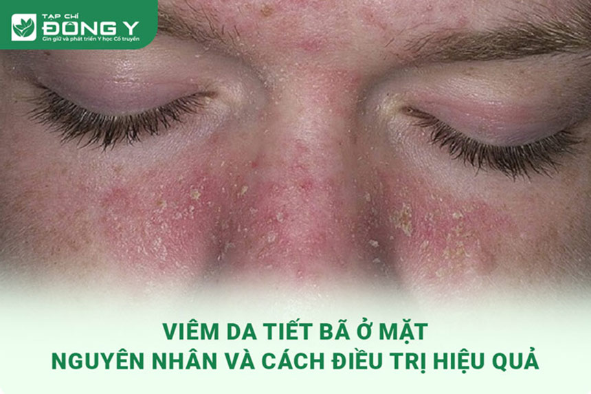 viem da tiet ba o mat