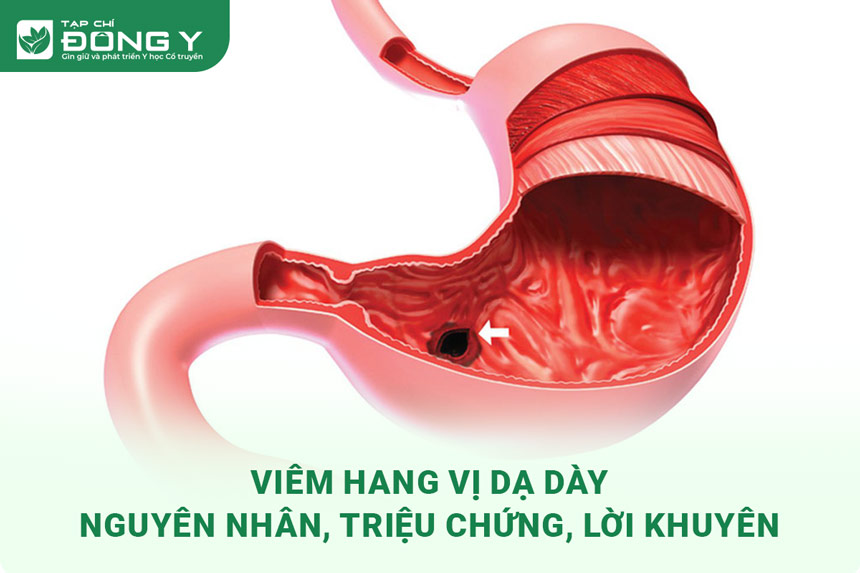 viem hang vi