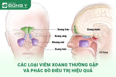 cac-loai-viem-xoang