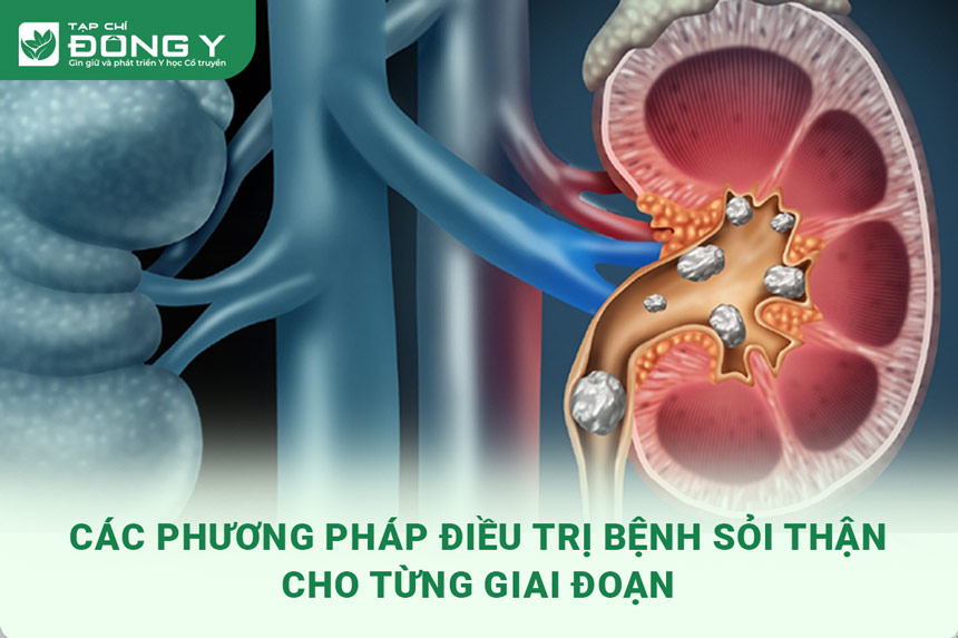 dieu-tri-benh-soi-than
